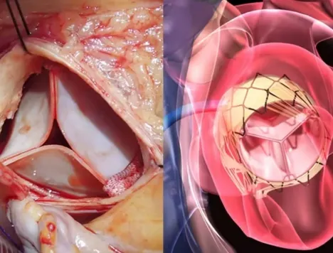 minimally-invasive-heart-valve-surgery