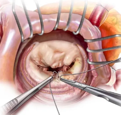 mitral-valve-repair-procedure-heart